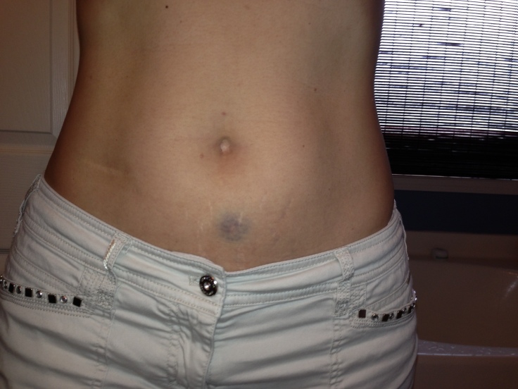 Belly Bruise